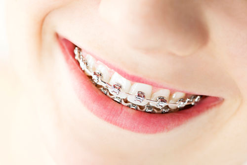 $1,000 OFF Braces For New Patient Special at Family Smiles Dental Care